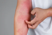 Penyebab Gatal pada Kulit yang Perlu Diketahui