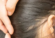 Cara Membasmi Kutu Rambut