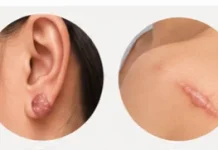 Keloid: Mengapa Bekas Luka Dapat Tumbuh Membesar?