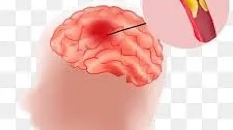 Gejala Stroke juga Bisa Dilihat dari Wajah