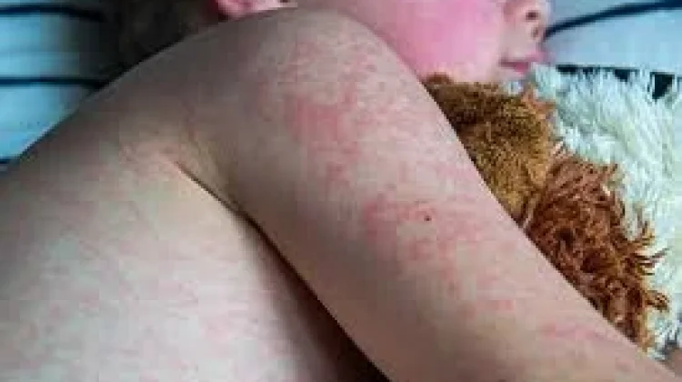 Bolehkah anak terkena campak beraktivitas di luar rumah?
