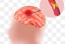 Gejala Stroke juga Bisa Dilihat dari Wajah