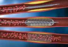 Stent, Solusi Medis untuk Mengatasi Penyumbatan Arteri Jantung
