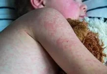 Bolehkah anak terkena campak beraktivitas di luar rumah?