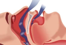 Bisa Picu Stroke, Obesitas Jadi Penyebab Utama Dengkuran saat Tidur