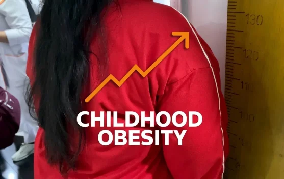 Jadi Sasaran Bullying, Ahli Ingatkan Dampak Obesitas Anak Tak Cuma Soal Fisik