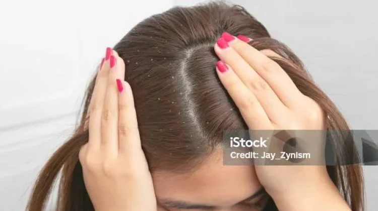 Tips Merawat Rambut Berketombe agar Tetap Sehat dan Lembap