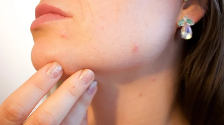 Tujuh Cara Menghilangkan Komedo di Hidung secara Alami dan Aman