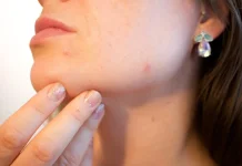 Tujuh Cara Menghilangkan Komedo di Hidung secara Alami dan Aman