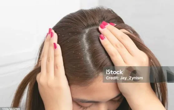 Tips Merawat Rambut Berketombe agar Tetap Sehat dan Lembap