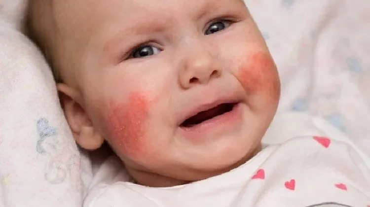 Dermatitis Atopik pada Bayi, Jangan Sepelekan