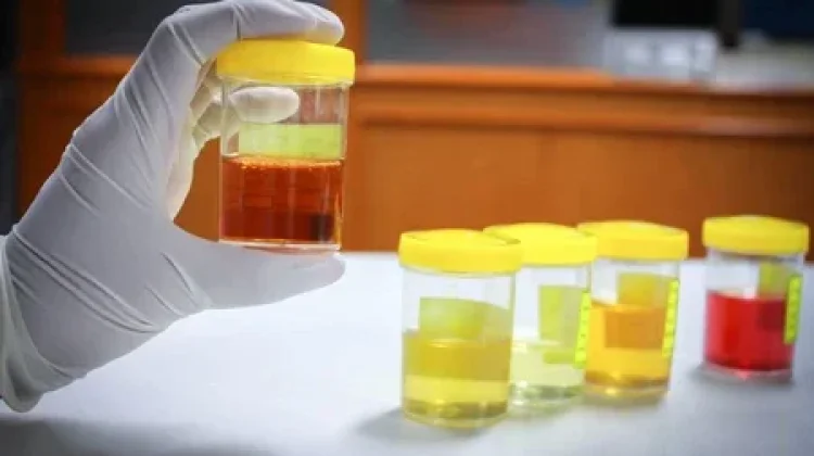 Waspada Warna Urine, Tanda Resiko Kesehatan Sering Diabaikan