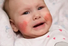 Dermatitis Atopik pada Bayi, Jangan Sepelekan