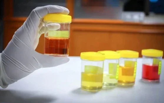 Waspada Warna Urine, Tanda Resiko Kesehatan Sering Diabaikan