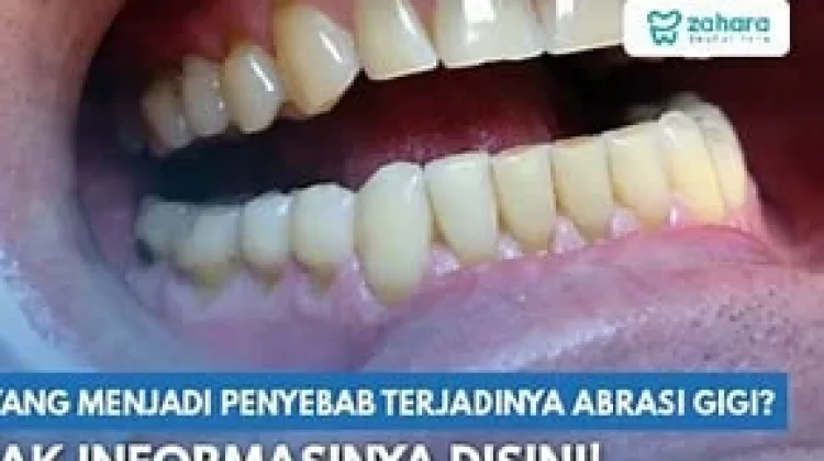 Abrasi Gigi, Kenali Penyebab dan Cara Mengatasinya
