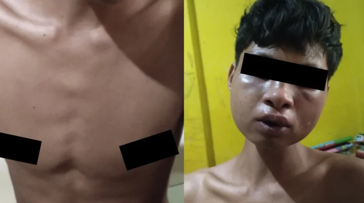 Anak di Bawah Umur Diduga Disulut Rokok dan Disetrum Oknum Anggota Polres Wakatobi