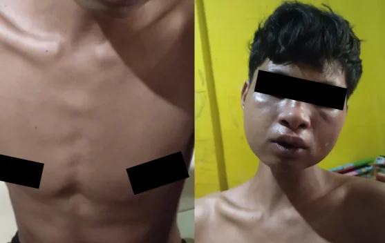 Anak di Bawah Umur Diduga Disulut Rokok dan Disetrum Oknum Anggota Polres Wakatobi