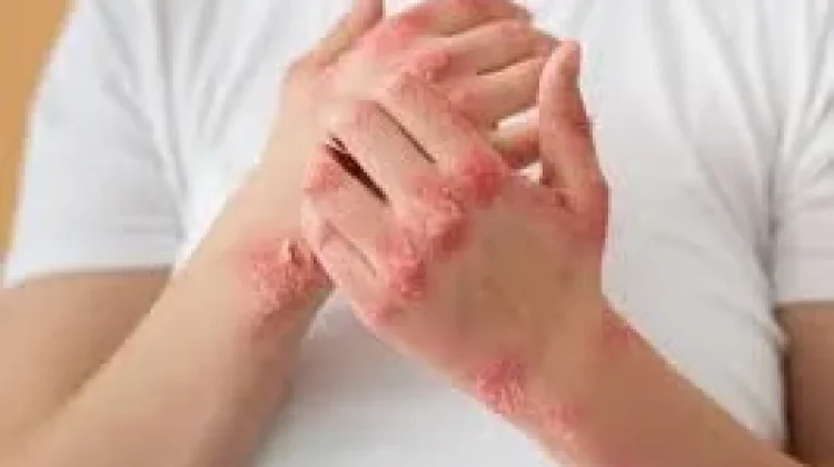 Obat Alami untuk Membantu Meredakan Dermatitis yang Kambuh