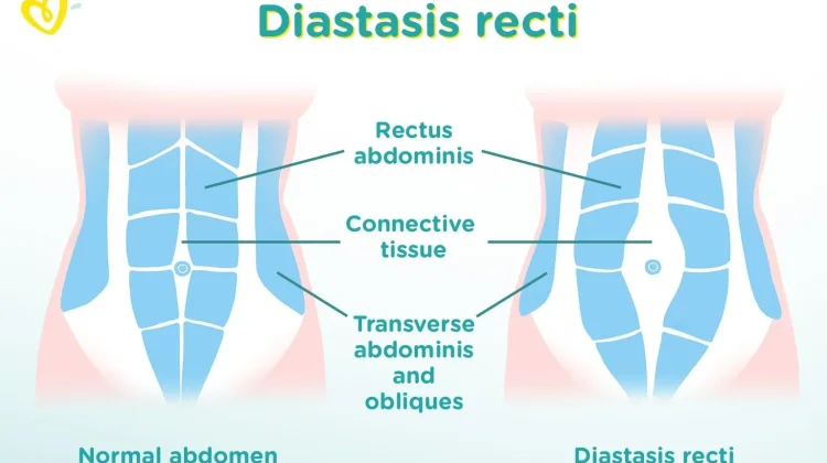 Mengenal Diastasis Recti, Celah Otot Perut yang Perlu Diwaspadai