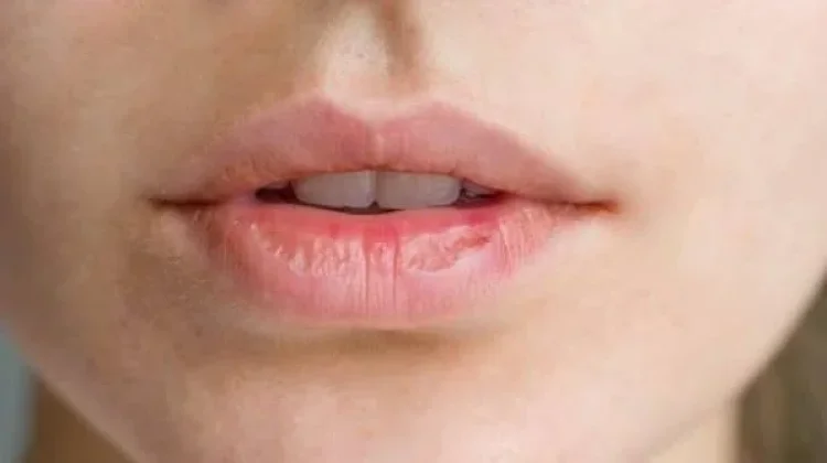 4 Penyebab bibir kering dan cara mengatasinya