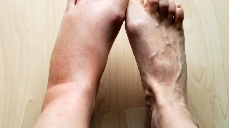 Kenali Ciri Kaki Bengkak karena Ginjal dan cara Mengatasinya