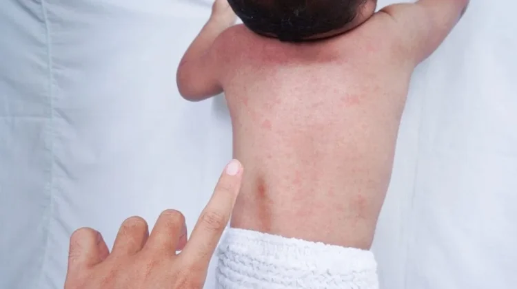 Cara Mengatasi Biang Keringat pada Bayi dan Obatnya