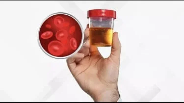 Kencing Berdarah? Ini Penyebab,Gejala, dan Pengobatannya