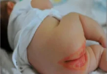 Penggunaan Pampers yang Tepat Melindungi Kulit Bayi dari Iritasi