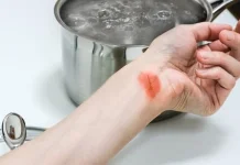 Kenali pertolongan pertama kena air panas