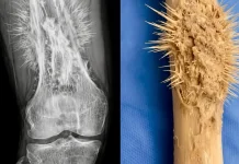Osteosarcoma: Kanker Tulang Ganas yang Kerap Disangka Cedera Biasa