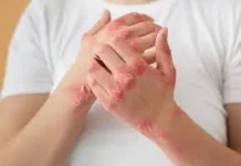 Obat Alami untuk Membantu Meredakan Dermatitis yang Kambuh