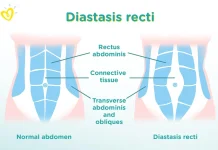 Mengenal Diastasis Recti, Celah Otot Perut yang Perlu Diwaspadai