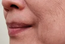 Treatment Non-Bedah Jadi Solusi Mengencangkan Kulit Kendur