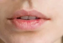 4 Penyebab bibir kering dan cara mengatasinya