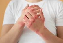 Kenali Gejala Lupus Sejak Dini, Waspadai Serangan Autoimun yang Mengancam