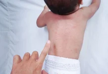Cara Mengatasi Biang Keringat pada Bayi dan Obatnya