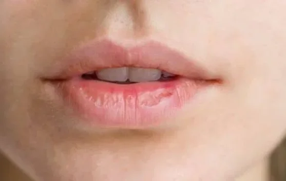 4 Penyebab bibir kering dan cara mengatasinya