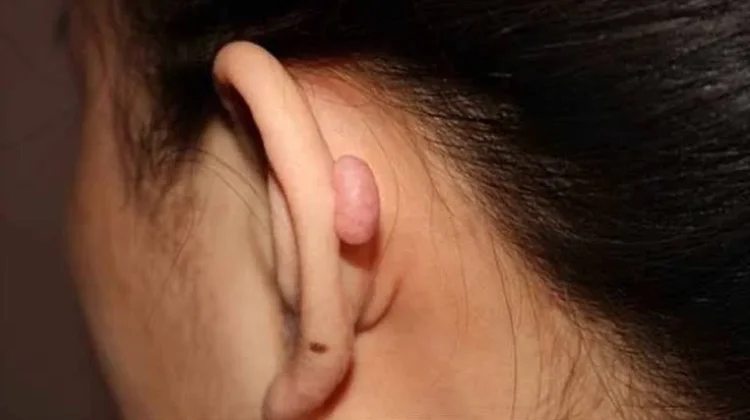 Mengenal Keloid Bukan Bekas Luka Biasa, Kenali Penyebabnya