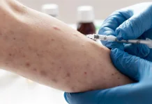 Kemenkes Minta Warga Waspadai Penularan Campak jelang Mudik dan Lebaran