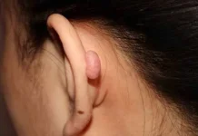 Mengenal Keloid Bukan Bekas Luka Biasa, Kenali Penyebabnya