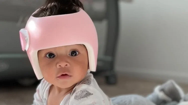 Mengenal Helm Khusus Bayi atau Helmet Therapy, Fungsi Medis atau Sekadar Gaya?