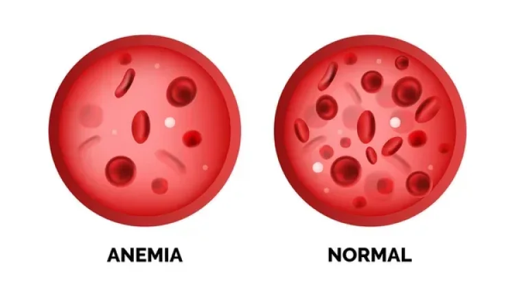 Anemia Tak Boleh Dianggap Sepele, Dampaknya Bisa Menurunkan Produktivitas