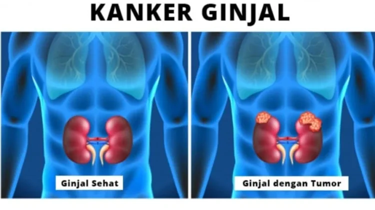 10 Gejala Kanker Ginjal Ini Jarang Disadari oleh Awam