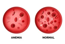 Anemia Tak Boleh Dianggap Sepele, Dampaknya Bisa Menurunkan Produktivitas