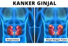 10 Gejala Kanker Ginjal Ini Jarang Disadari oleh Awam