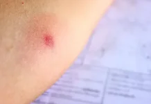Mengenal Metode Scoring dan Uji Mantoux untuk Diagnosis TBC Anak