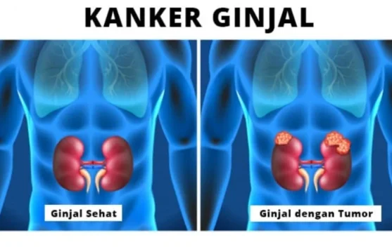 10 Gejala Kanker Ginjal Ini Jarang Disadari oleh Awam