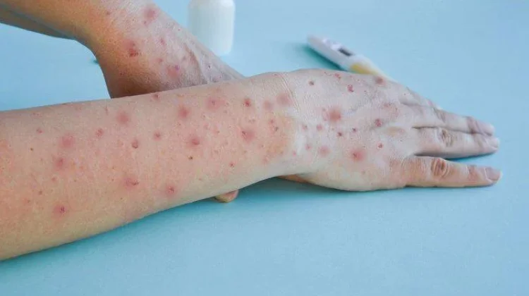 Waspada Cacar Air di Musim Pancaroba