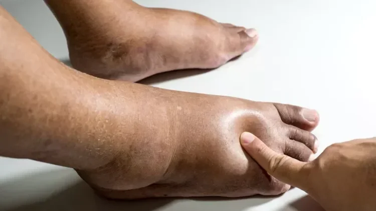 Penyebab Kaki Bengkak dan Cara Mengatasinya