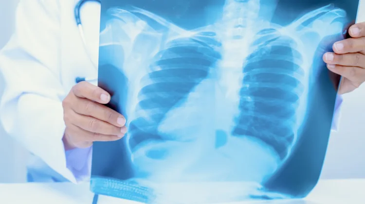 Gunakan X-Ray Portable, Sulsel Percepat Temukan Kasus TBC